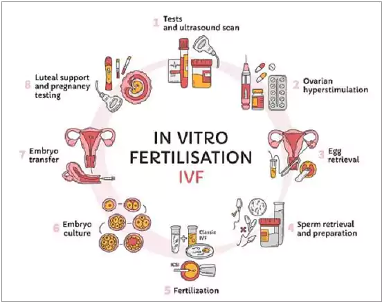 Definition of In-vitro-fertility1
